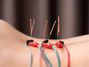 electro acupuncture on back
